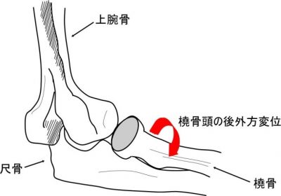 肘関節の後外方回旋不安定性 カイロプラクティックジャーナル
