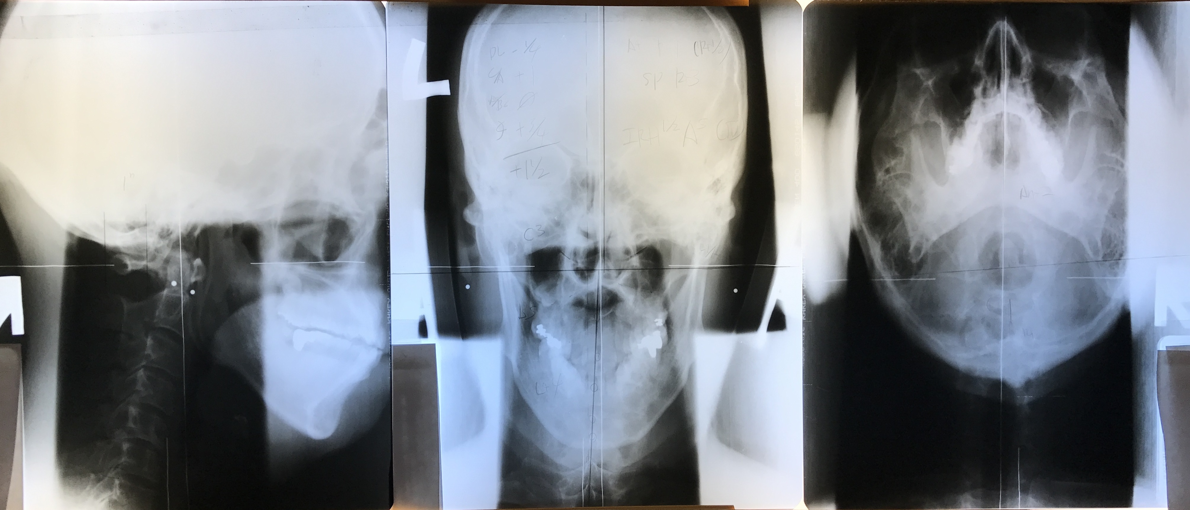 上部頸椎セット(Lateral, Vertical, Nasium)のレントゲン写真